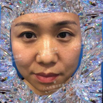 八大处整形郭鑫：眼部整形大约多少钱