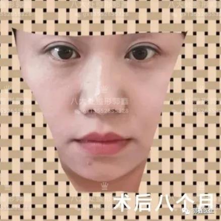 八大处整形郭鑫：眼部整形大约多少钱