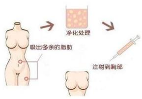 煤医整形：自体脂肪丰胸的四大优势