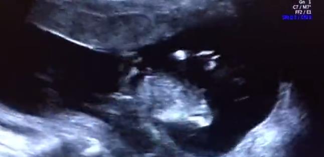 天津天孕医院做四维怎么样 看双胞胎孕妈如何说