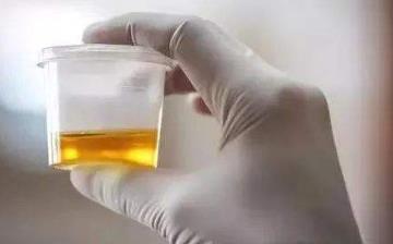 【尿黄】尿黄的原因_尿很黄是怎么回事_尿黄有异味正常吗_长期尿黄是什么病 【尿黄】尿黄的原因_尿很黄是怎么回事_尿黄有异味正常吗_长期尿黄是什么病