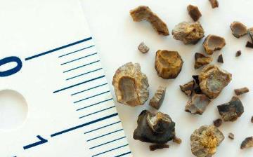 【尿结石】尿结石怎么引起的_尿结石症状及最佳治疗方法_尿结石和肾结石的区别