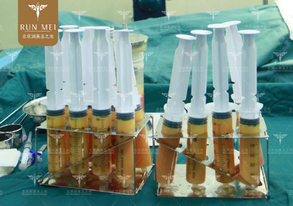 北京润美玉之光张红芳丨自体脂肪精度填充，在细节上提升效果