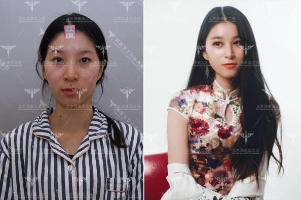 北京润美玉之光张红芳丨自体脂肪精度填充，在细节上提升效果