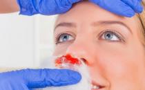 好用的止鼻血的方法 食物也能治疗流鼻血