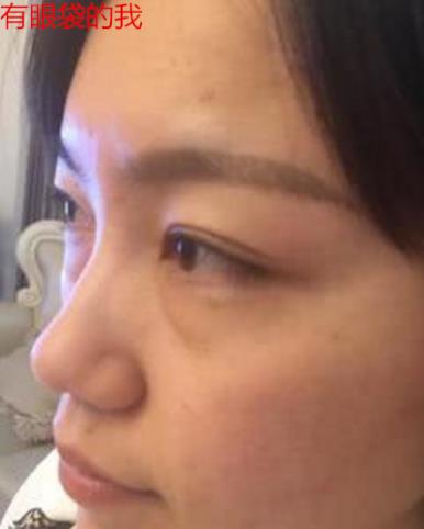 卫娅日记:我一直都以为眼袋对我的影响只是美观,直到我了解了以后……