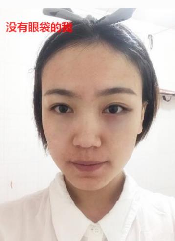 卫娅日记:我一直都以为眼袋对我的影响只是美观,直到我了解了以后……