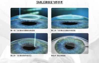 西安普瑞眼科医院治疗近视好?参军入伍,近视手术提前半年做准备