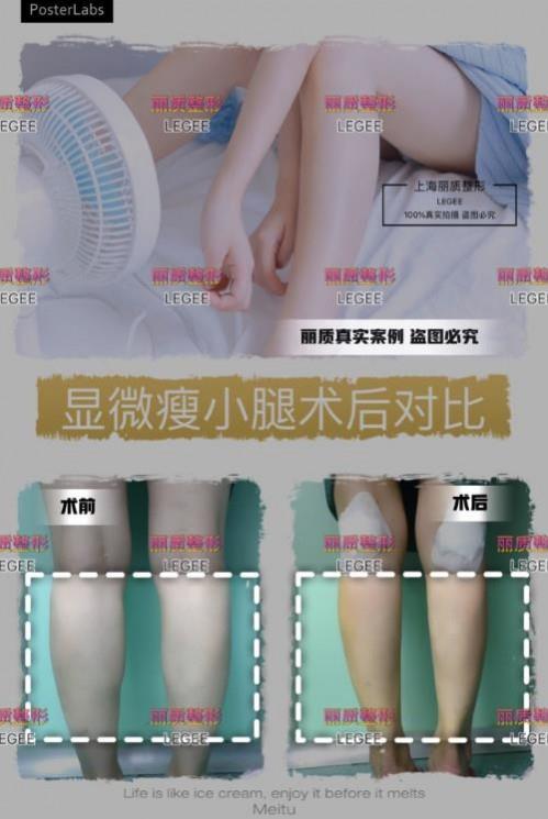 上海丽质美学整形门诊部做瘦小腿价格贵吗？肌肉小腿太难减怎么办