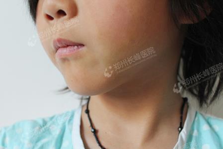 海绵状血管瘤的费用怎么计算？