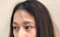 君雅笔记：眼袋过重，就会显得比真实年龄大，要如何修复眼袋呢？