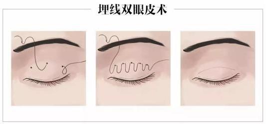 上海玫瑰整形医院双眼皮手术怎么样？轻松拥有靓丽双眼