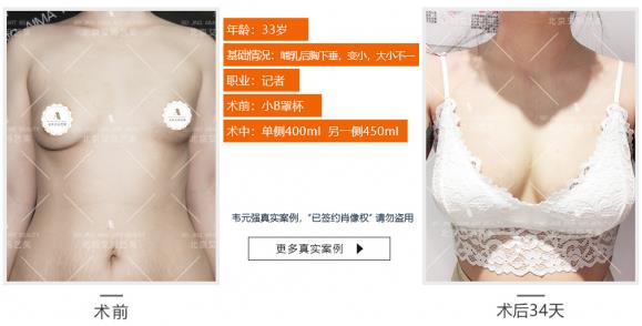 韦元强：产后能做自体脂肪丰胸吗？