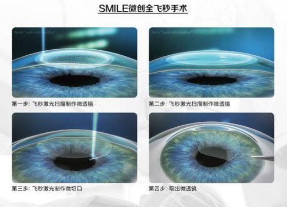 西安普瑞眼科医院好吗？戴眼镜VS近视手术，四个对比让你不纠结