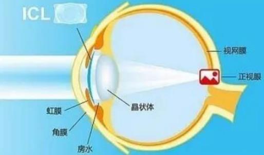 西安普瑞眼科医院好吗？戴眼镜VS近视手术，四个对比让你不纠结