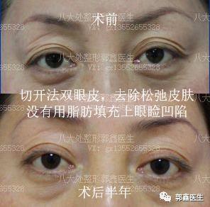 八大处整形郭鑫：上眼睑凹陷脂肪填充图片