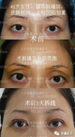 八大处整形郭鑫：上眼睑凹陷脂肪填充图片