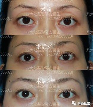 八大处整形郭鑫：上眼睑凹陷脂肪填充图片