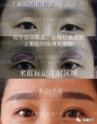 八大处整形郭鑫：上眼睑凹陷脂肪填充图片