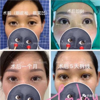 八大处整形郭鑫：上眼睑凹陷脂肪填充图片