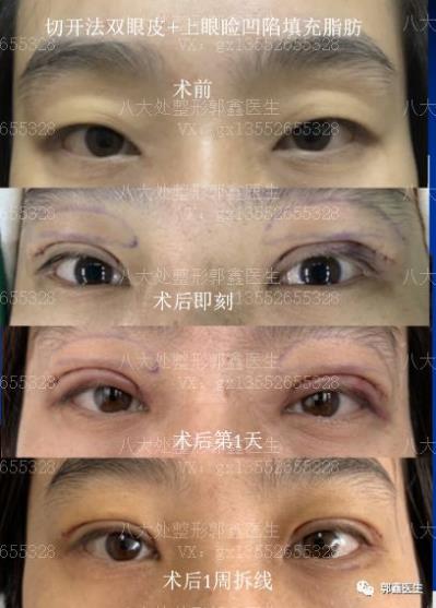 八大处整形郭鑫：上眼睑凹陷脂肪填充图片