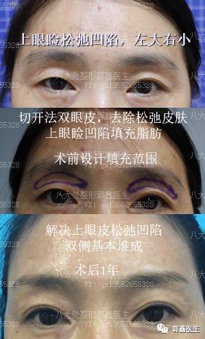 八大处整形郭鑫：上眼睑凹陷脂肪填充图片