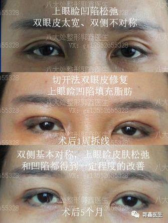 八大处整形郭鑫：上眼睑凹陷脂肪填充图片