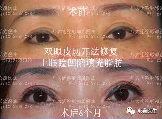八大处整形郭鑫：上眼睑凹陷脂肪填充图片