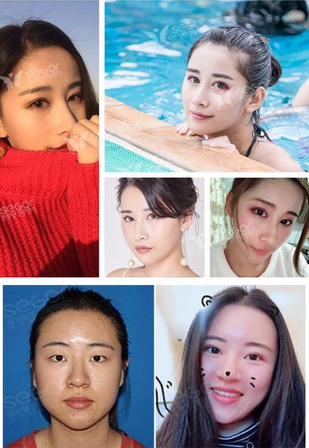 常州曙光美容医院做眼部整形怎么样 安全自然定制美丽