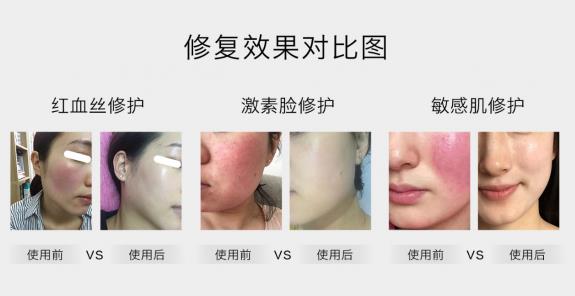 放心!有美薏升修复敏感肌红血丝专家产品在,你每天都可以美美哒