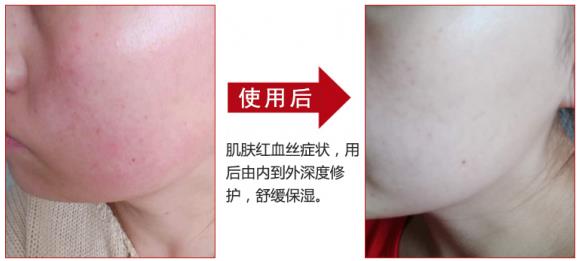 放心!有美薏升修复敏感肌红血丝专家产品在,你每天都可以美美哒
