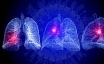 国产AI助力全球抗疫|FDA许可科亚医疗「智能分诊系统」疫情临床应用和销售