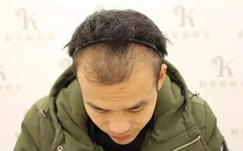 青岛大麦微针植发2500毛囊单位，术后8个月恢复头发浓密