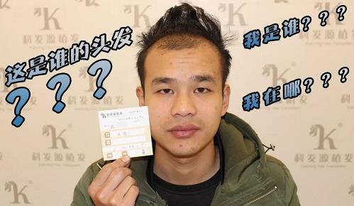 青岛大麦微针植发2500毛囊单位，术后8个月恢复头发浓密