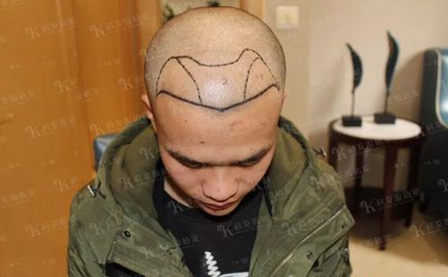 青岛大麦微针植发2500毛囊单位，术后8个月恢复头发浓密