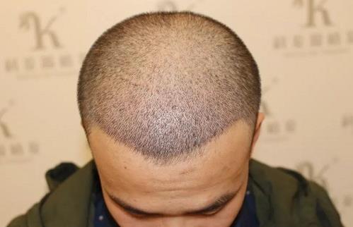 青岛大麦微针植发2500毛囊单位，术后8个月恢复头发浓密