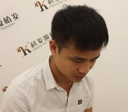 青岛大麦微针植发2500毛囊单位，术后8个月恢复头发浓密