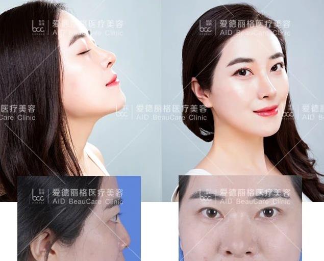 大连爱德丽格“你好美鼻”免费鼻部模特招募活动完美落幕