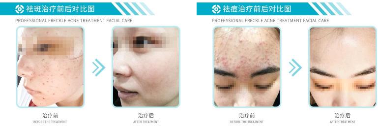 白博士祛痘祛斑怎么样？