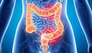 昆明东大肛肠医院提醒:肠癌高发这六类人肠镜检查费用一定不能省