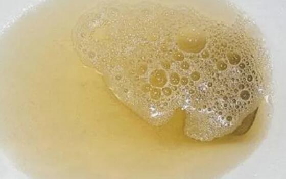 蛋白尿吃什么药好得快