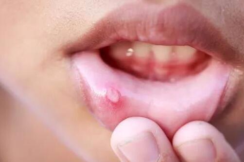 嘴角起小水泡怎么回事，嘴角起了一堆小水泡怎么办