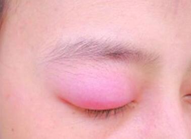 眼皮肿是怎么回事，眼皮肿是怎么快速消除