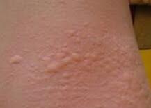 浑身痒是怎么回事,老人浑身起疙瘩浑身痒是怎么回事