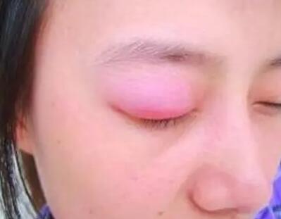 眼皮肿是怎么回事(眼皮肿是怎么快速消除)